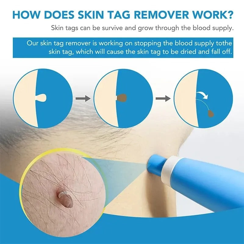 Belro Skin Tag Removal Kit for men, includes tools and supplies for safe skin tag treatment.