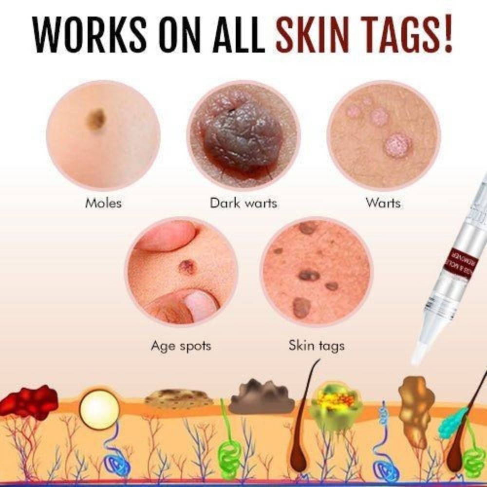 Belro Tags & Moles Remover device for skin care, shown in close-up with a focus on the handheld tool and skin.