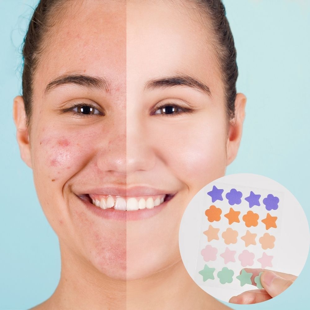 Belro hydrocolloid pimple acne patch sticker for men, showing clear, skin-colored adhesive patches on a person's face.