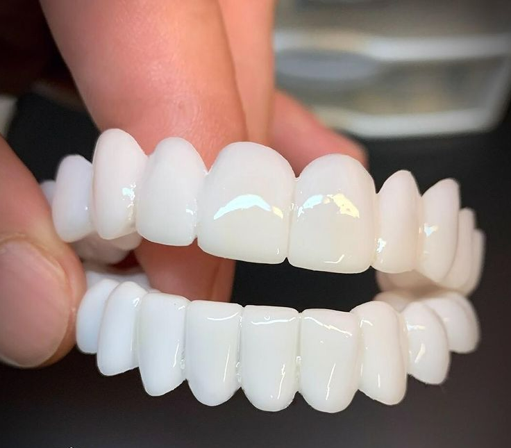 Flexible Sandsberg20250613 dental prosthesis by BowLift, natural-looking fit and pain-free comfort in a close-up image.