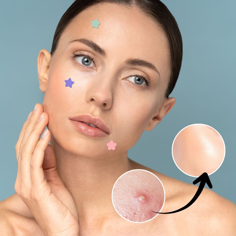 Belro hydrocolloid pimple acne patch sticker for men, small transparent skin-colored acne treatment sticker on a clear background.