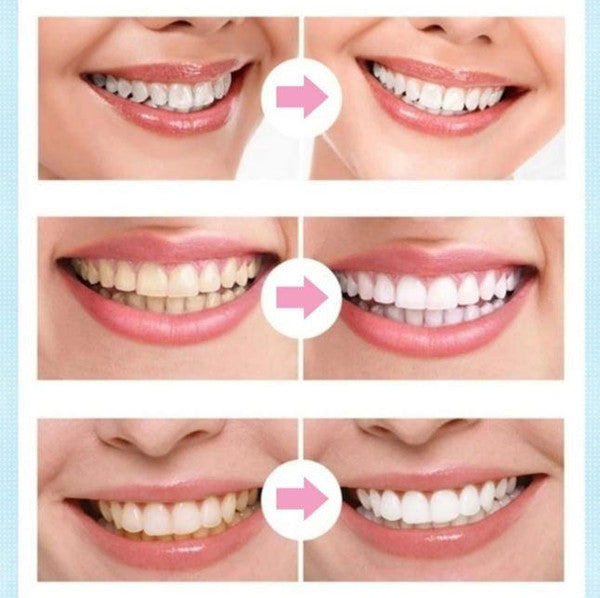 Belro dental whitening pen for oral care, featuring a sleek design and precision applicator for brightening teeth.