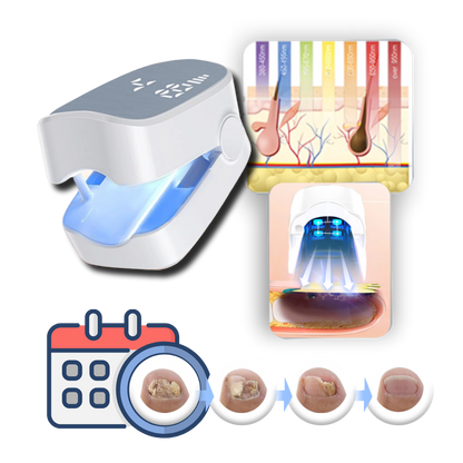 Belro painless laser treatment device for nail fungus, showing the sleek handheld tool used in health and beauty procedures.