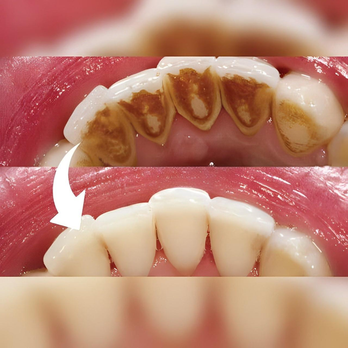 Belro Professional Dental Scaler showing detailed tip and electronic design for effective dental cleaning.
