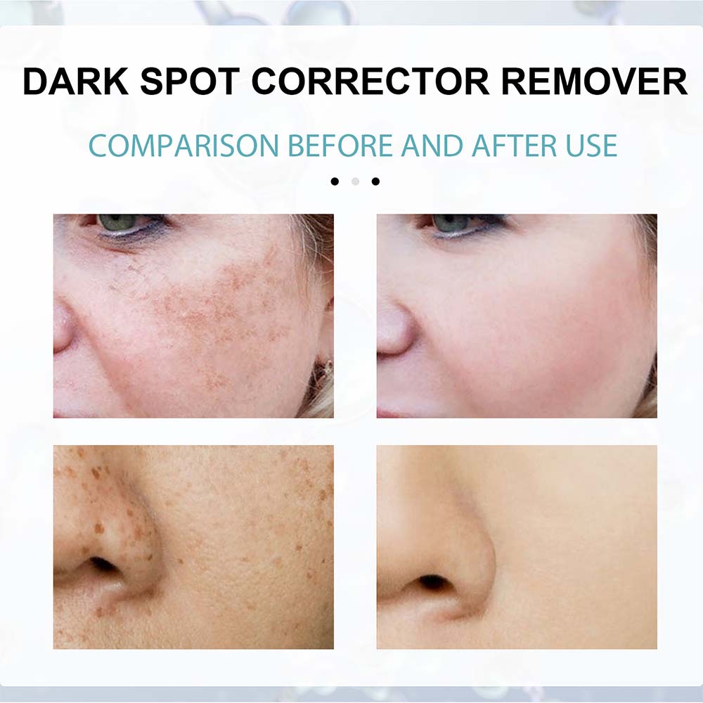 Belro anti-dark spot skin care bottle with lightening formula for pigmentation spots on a white background