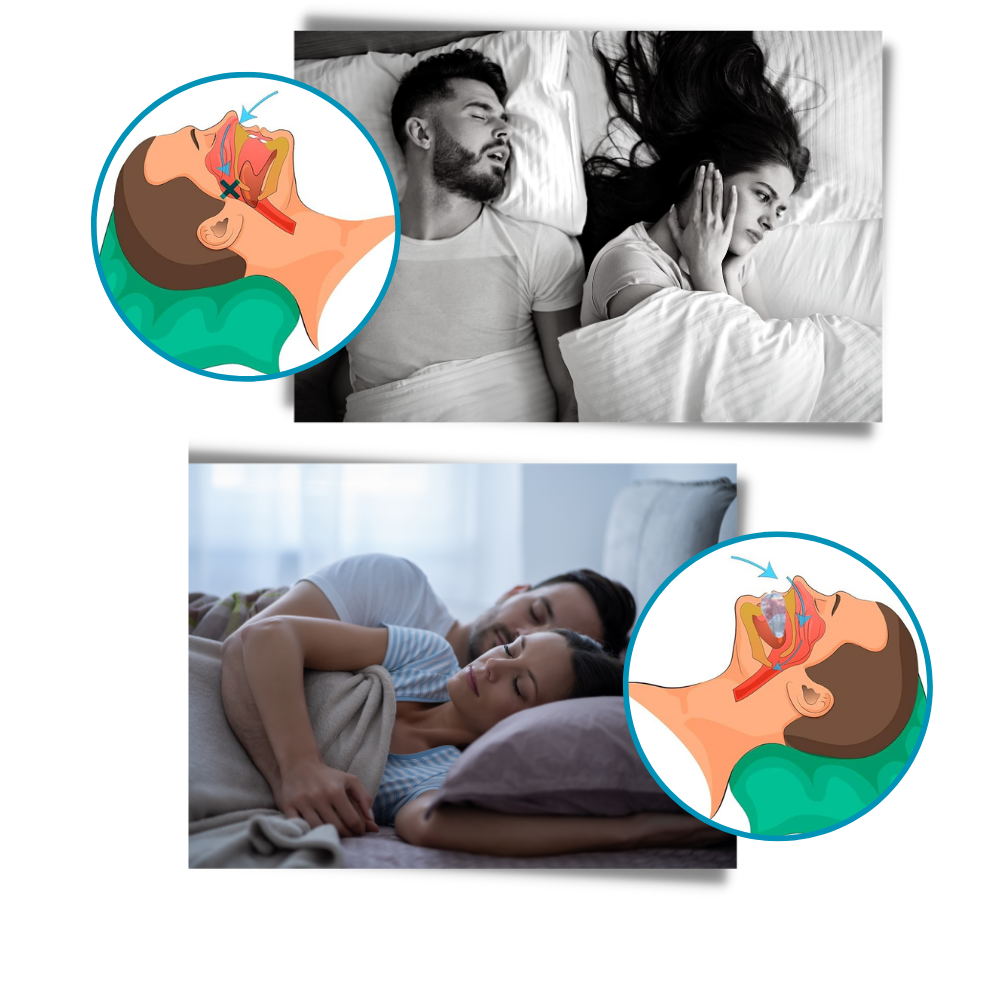 Belro advanced anti-snoring device designed to reduce snoring, shown in a sleek, compact form suitable for sleep aid use.