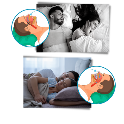 Belro advanced anti-snoring device designed to reduce snoring, shown in a sleek, compact form suitable for sleep aid use.