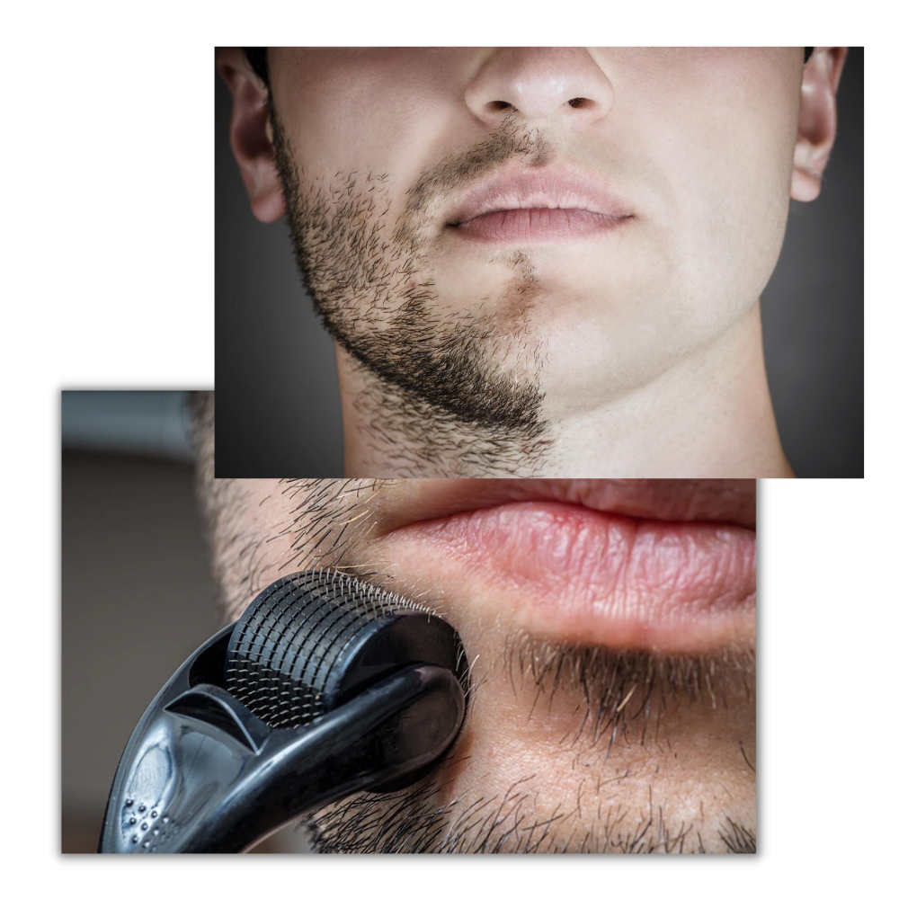 Belro dermal roller for hair and beard growth, showing a close-up of the handheld skin care tool with fine needles.