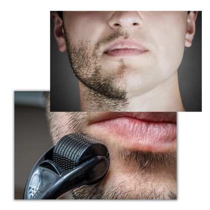 Belro dermal roller for hair and beard growth, showing a close-up of the handheld skin care tool with fine needles.