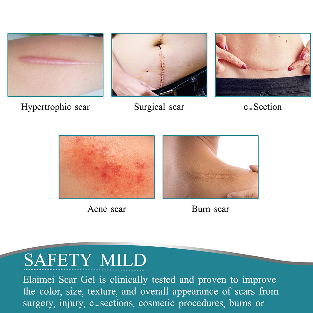 Belro silicone scar tape roll for scar management, soft and flexible medical-grade silicone for healing and skin care.