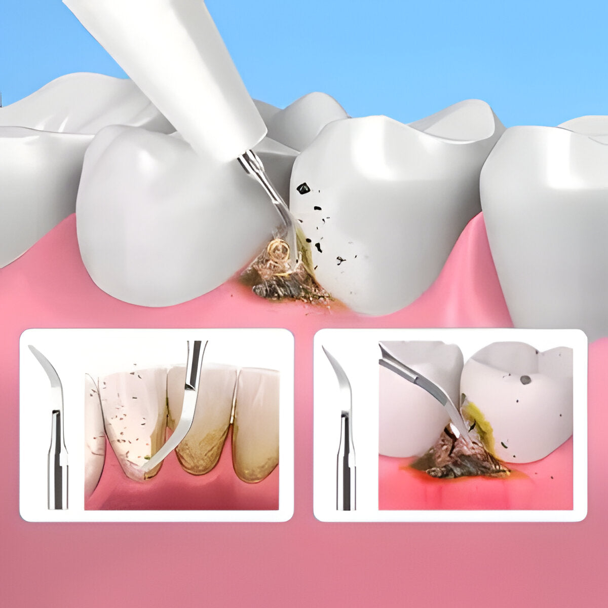 Belro ultrasonic scaler in electronics, showing the handheld device with sleek design and control buttons for dental cleaning.