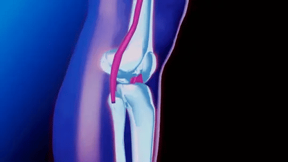 Belro knee support with adjustable compression for pain relief, injury recovery, arthritis, and sports stability, shown in the image.