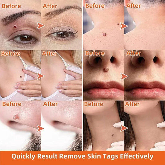 Belro Auto Skin Tag Remover Painless device for safe, effective removal of skin tags, featuring a compact design and easy-to-use interface.
