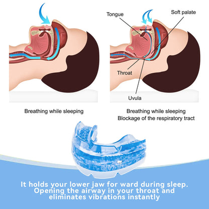 Belro adjustable anti-snore mouthpiece designed to reduce snoring and improve sleep comfort, shown on a white background.
