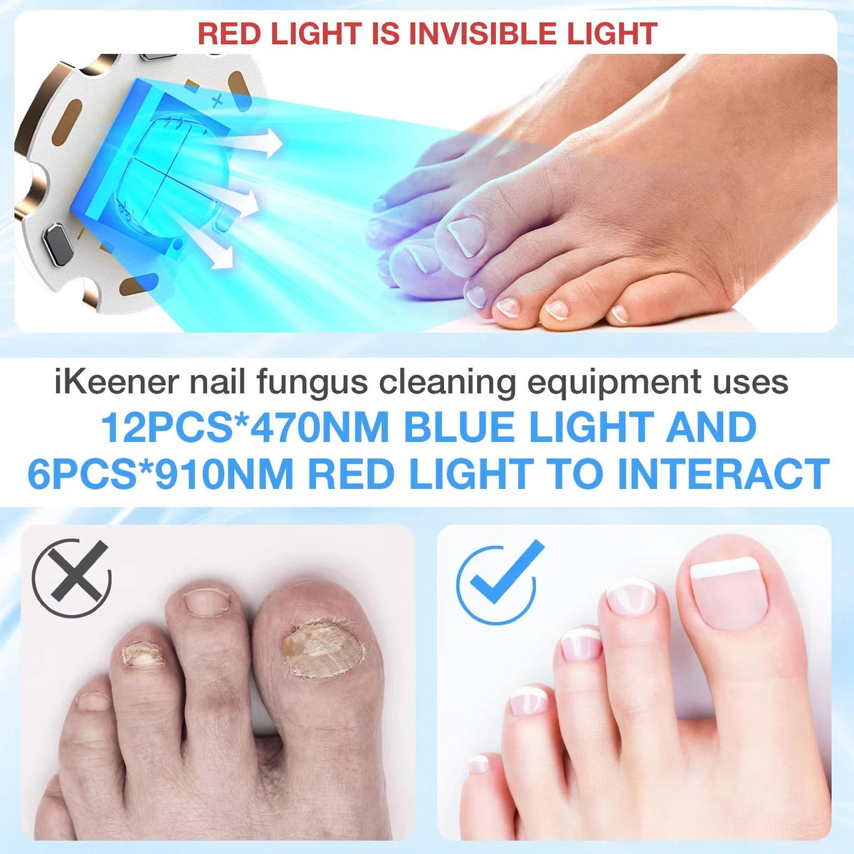Belro Nail Fungus Laser device for treating nail infections, featuring a sleek LED light design for effective home use.