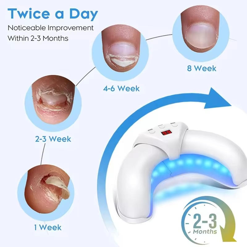 Belro nail fungus laser device for targeted LED light therapy, used to treat nail fungal infections effectively.