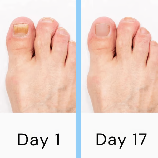 Belro Nail Laser Fungus Device for health and beauty, shown in use on toenail to treat fungal infections.