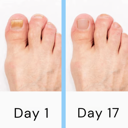 Belro Nail Laser Fungus Device for health and beauty, shown in use on toenail to treat fungal infections.