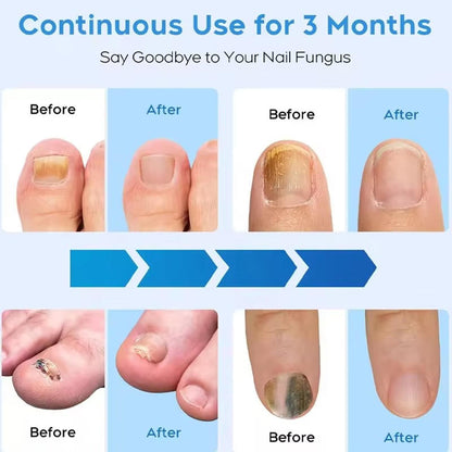 Belro nail fungus laser device for treating nail infections, featuring sleek electronic design and LED light technology.