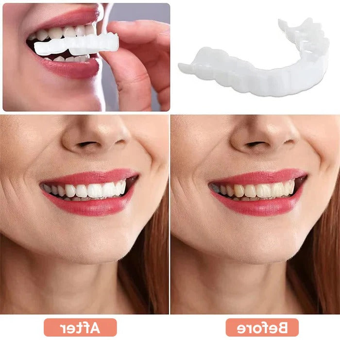 Belro teeth veneers with natural white finish, showcasing a close-up of the smooth, aesthetic dental veneer for improved smile appearance.