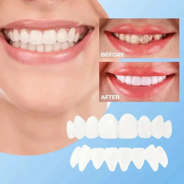 Belro teeth veneers with natural white finish, showcasing a close-up of the smooth, healthy-looking dental surface.