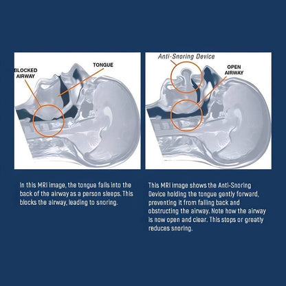 Belro sleep apnea tongue retainer for snoring relief, non-invasive sleep aid device used to improve airflow during sleep.