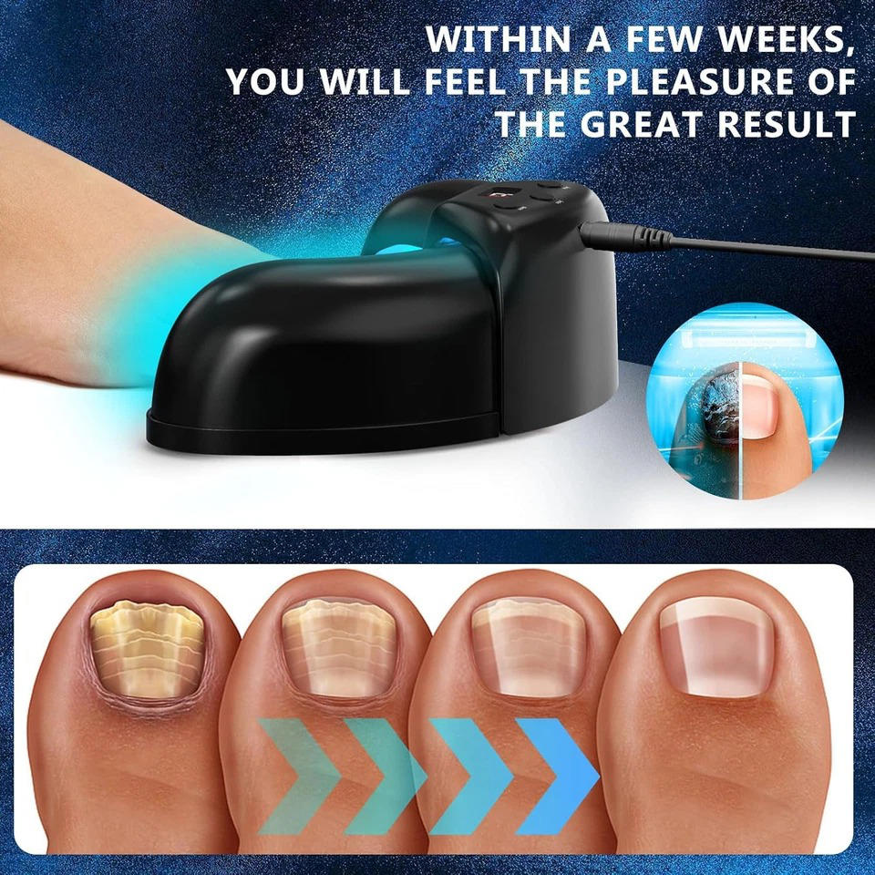 Belro Nail Fungus Laser device, compact electronic LED light used for fungal treatment on nails, shown in a sleek, modern design.