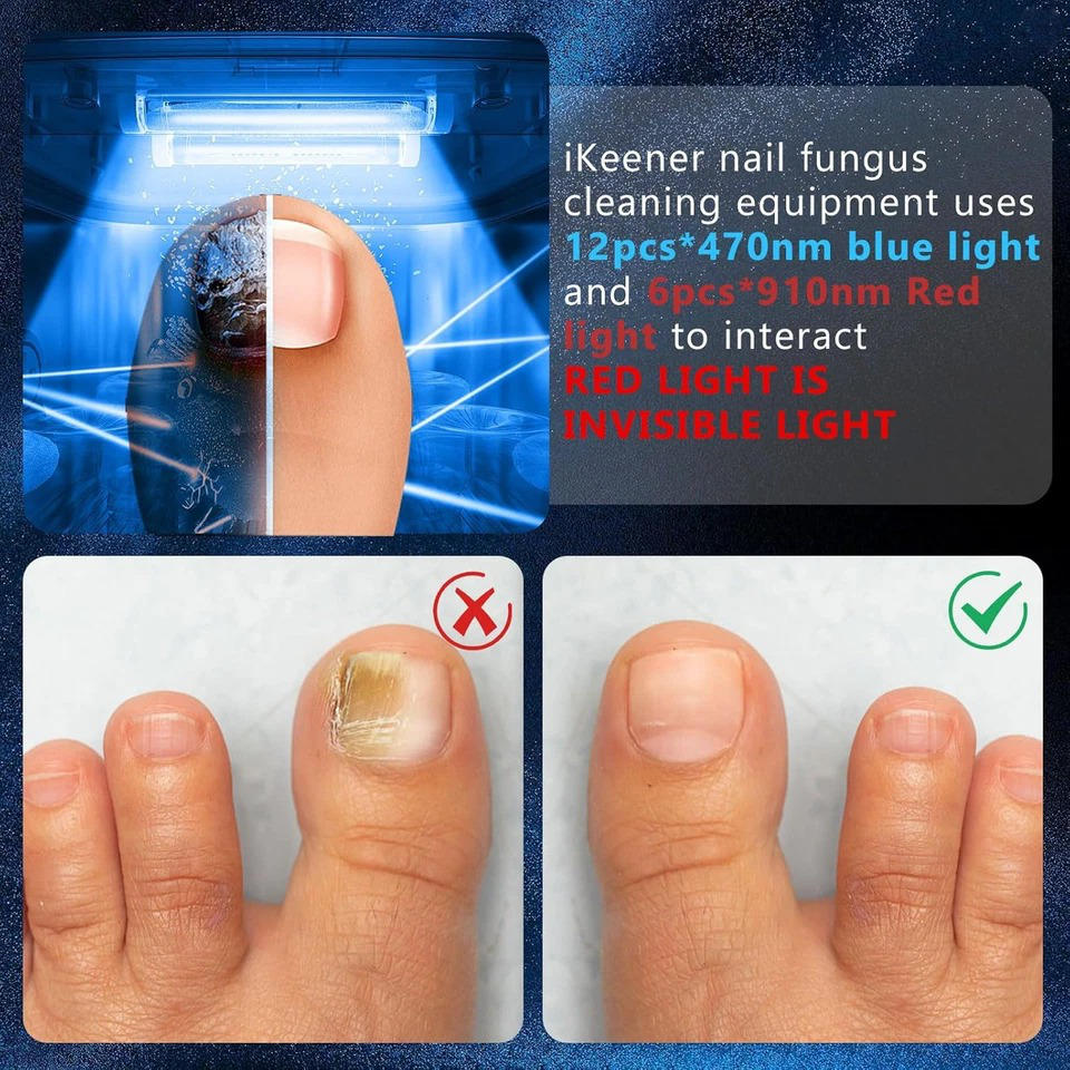Belro nail fungus laser device with LED light technology for fungal treatment, shown in a sleek electronic design.