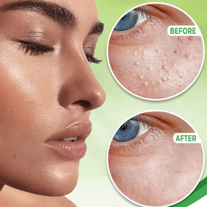 Belro Eye Milia Removal Cream in a sleek tube, designed for skin care and beauty treatments targeting milia removal around the eyes.