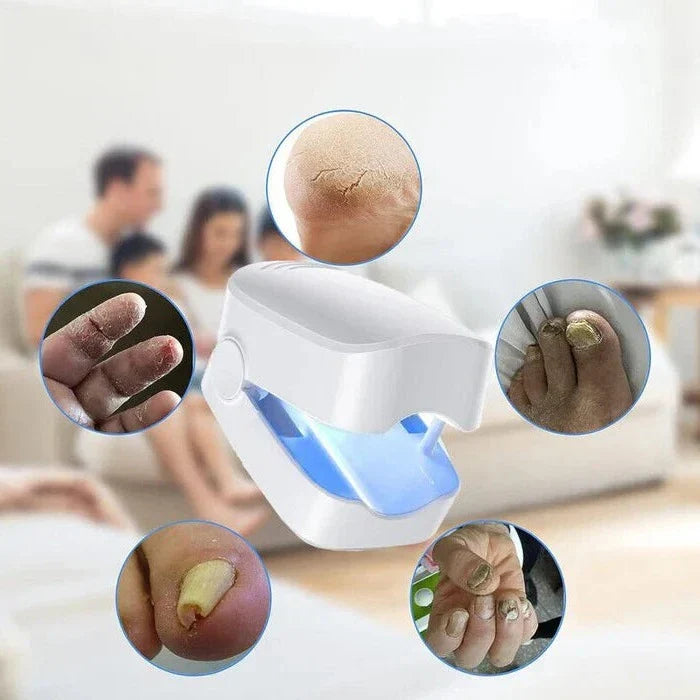 Belro Nail Fungus Cleaning Laser Device used for toenail health and fungal treatment with high-efficiency light therapy.