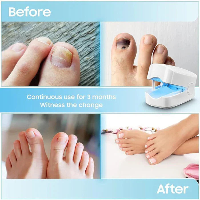Belro Nail Fungus Cleaning Laser Device for toenail infections, featuring high-efficiency light therapy for health and beauty care.