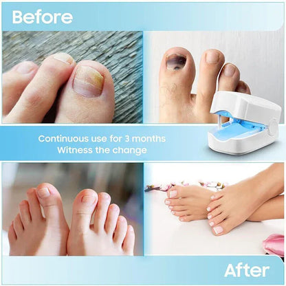 Belro Nail Fungus Cleaning Laser Device for toenail infections, featuring high-efficiency light therapy for health and beauty care.