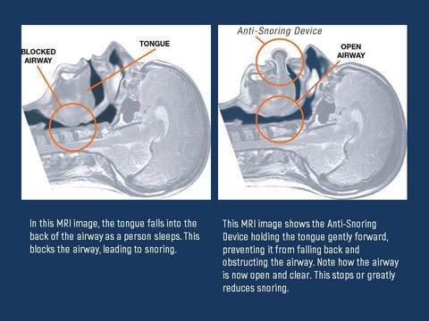 Belro Apnea Tongue Stabilizing Device for sleep apnea, showing the mouthpiece and adjustable strap in a close-up view.
