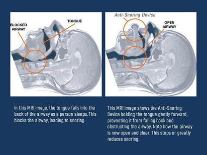 Belro Apnea Tongue Stabilizing Device for sleep apnea, showing the mouthpiece and adjustable strap in a close-up view.