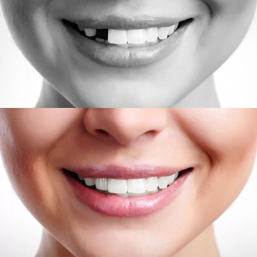 Belro moldable false teeth for oral care, showing the customizable dental appliance designed for comfort and fit.