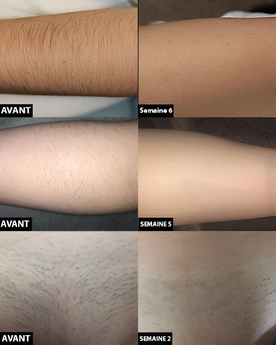 Belro permanent laser hair removal device for smooth, hair-free skin, showcasing the sleek handheld design and control panel.