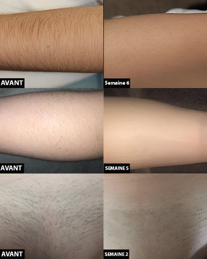 Belro permanent laser hair removal device for smooth, hair-free skin, showcasing the sleek handheld design and control panel.